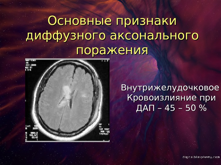 Признаки диффузных. Диффузное аксональное повреждение кт. Кт головного мозга ДАП. Кт при диффузном аксональном повреждении. Признаки аксонального поражения.