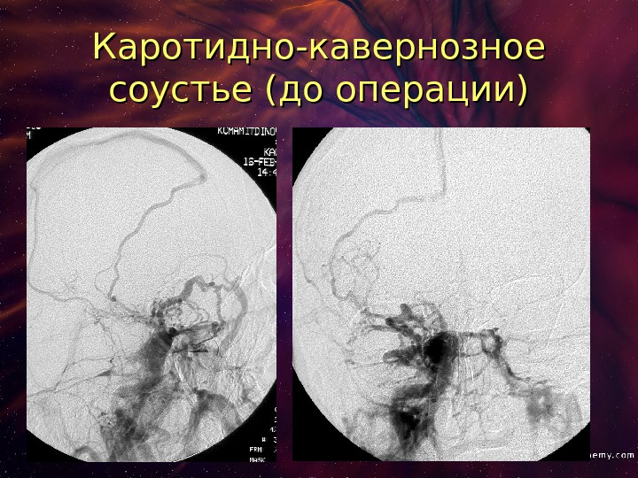 Соустье. Операция каротидно-кавернозное соустье. Тромбоз каротидно-кавернозного соустья. Каротидно-кавернозное соустье мрт.