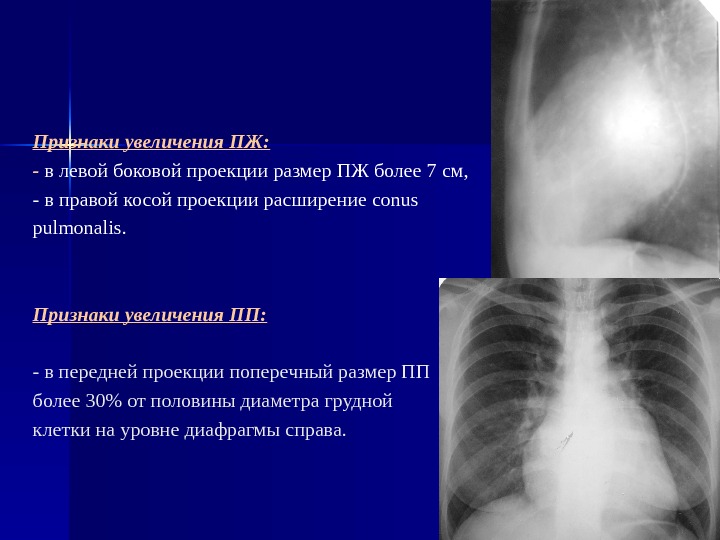 Увеличение правого. Симптом шапочки в левой передней косой проекции. Конус пульмоналис. Выбухание conus pulmonalis на рентгене.