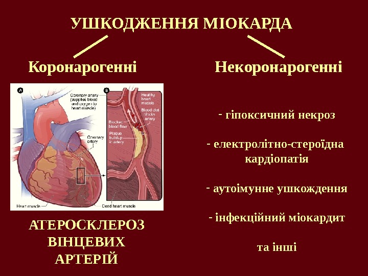 Нарушение коронарного кровообращения боковой стенки