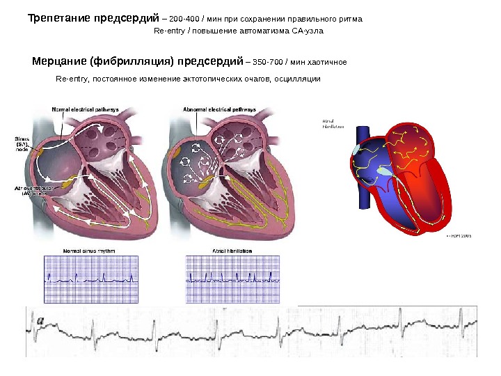 Отличие предсердий от желудочков. Трепетание предсердий и желудочков на ЭКГ. Фибрилляция и трепетание предсердий на ЭКГ отличия. Фибрилляция и трепетание предсердий на ЭКГ. Фибрилляция желудочков на ЭКГ.