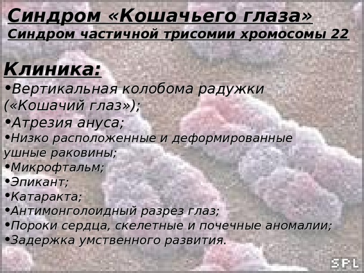 Хромосом глаз. Синдром частичной трисомии по короткому плечу. Синдром частичной трисомии 9. Синдром частичной трисомии по короткому плечу хромосомы 9 9 р+. Трисомия по короткому плечу 9 хромосомы.