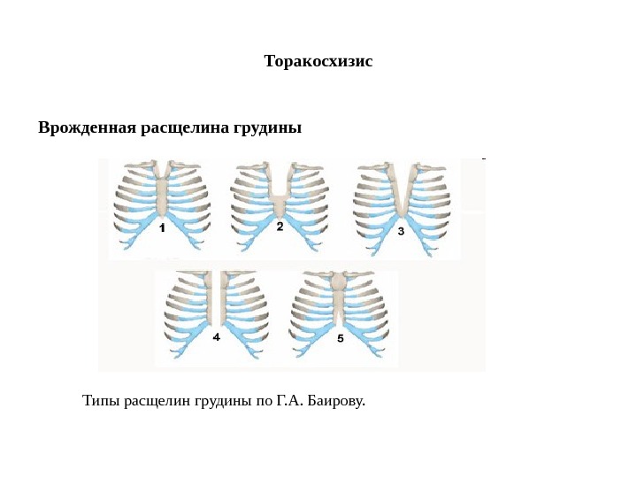 Формы грудины женские картинки