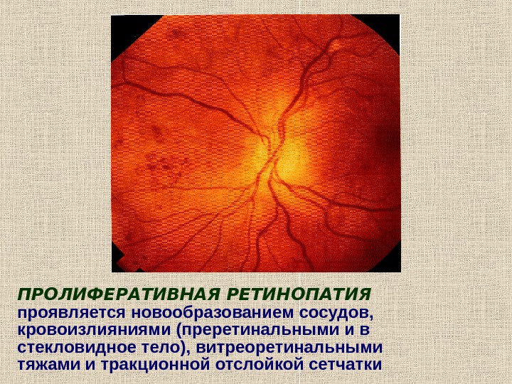 Изменение глазного дна при сахарном диабете презентация