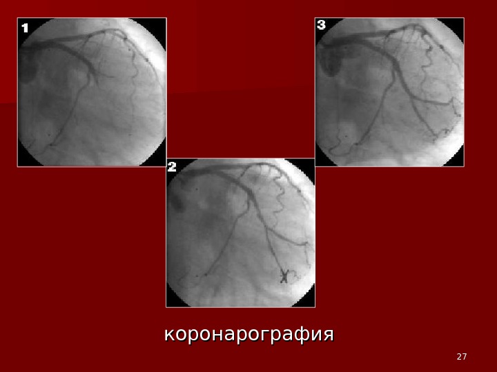 Коронарография контраст. Контрастная коронарография. Коронарография презентация. Осложнения коронарографии. Контраст для коронарографии.