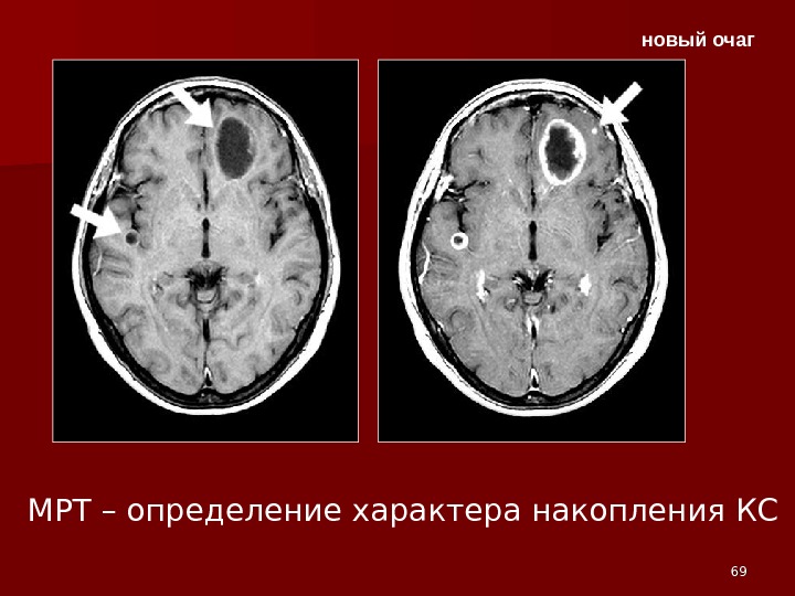 Что значит солидные очаги. Очаг накапливающий контраст в головном мозге. Мрт с контрастом очаги. Накопление контраста на мрт. Очаг накапливает контрастное вещество.