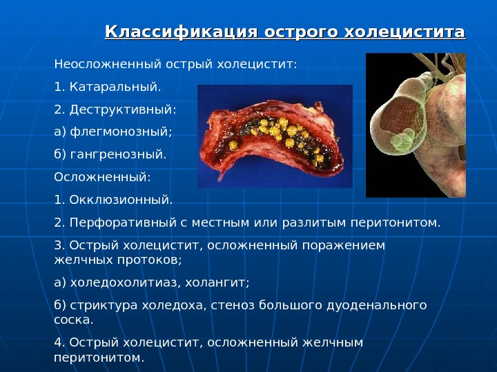 Презентация калькулезный холецистит