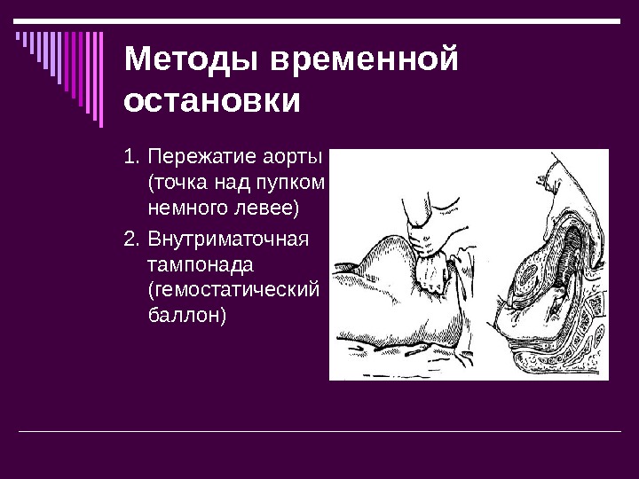 Способ временной. Методы остановки кровотечения в послеродовом периоде. Внутриматочный гемостатический баллон. Методы остановки кровотечения в акушерстве. Тампонада матки при кровотечении.