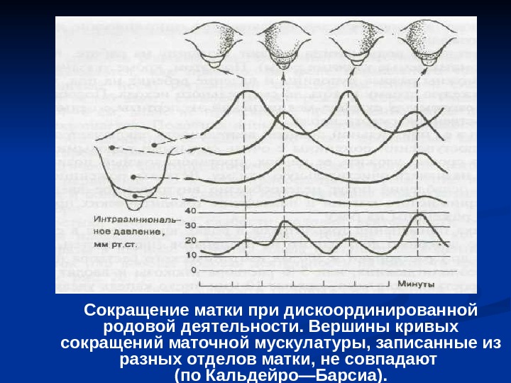 Сокращения матки после. Дискоординированная родовая деятельность партограмма. Сокращение матки при дискоординированной родовой деятельности. Аномалии родовой деятельности схема.