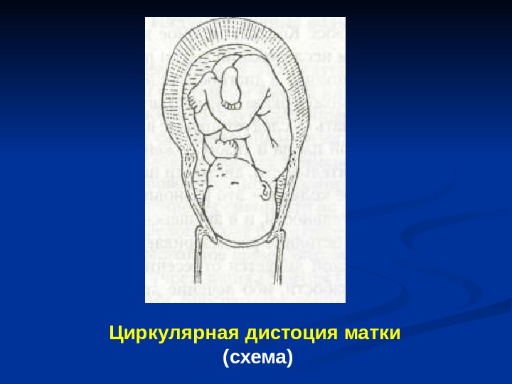 Дистоция шейки матки это. Циркулярная дистоция матки. Циркуляторная дистоция шейки матки. Циркуляторная дистония матки.