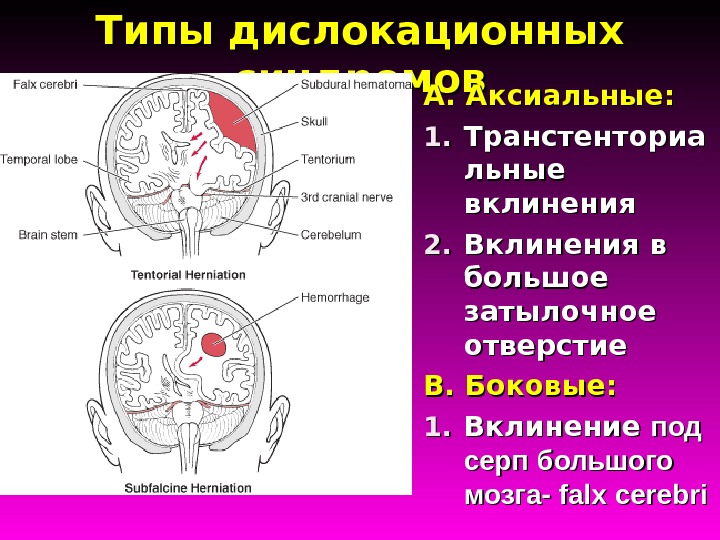 Пересадка головного мозга