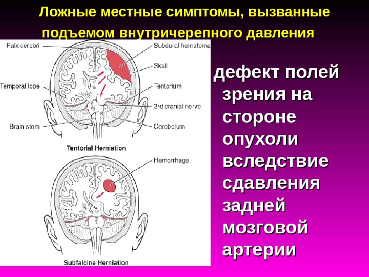 Признаки опухоли головного мозга