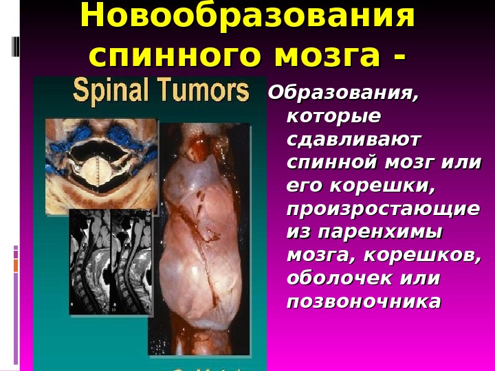 Презентация Лекция 3 Опухоли головного и спинного мозга