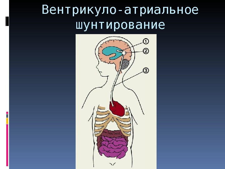 Шунт головного мозга