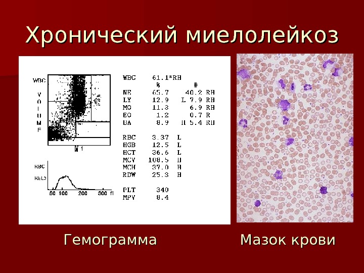 Наиболее часто в клинической картине при взрослом типе хронического миелолейкоза встречается