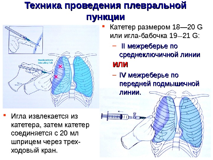 Экссудативный плеврит пункция