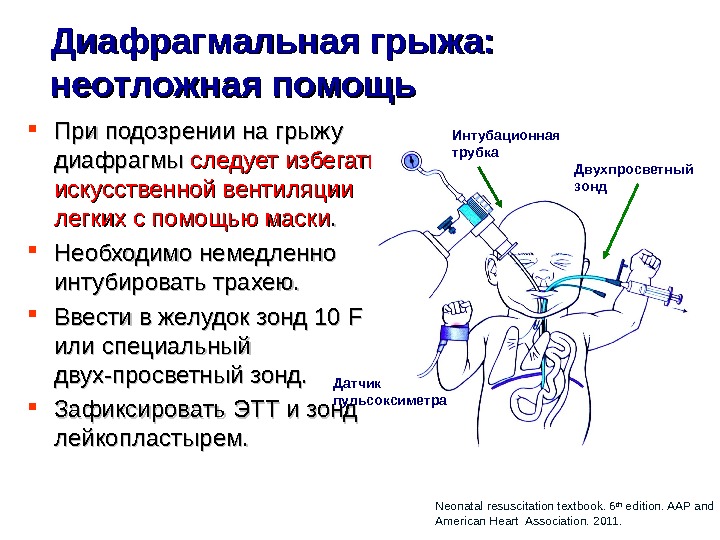 Симптом диафрагмы. Врожденная диафрагмальная грыжа симптомы. Левосторонняя врожденная диафрагмальная грыжа. Методы операции врожденной диафрагмальной грыжи. Поддиарагмальная грыжа.