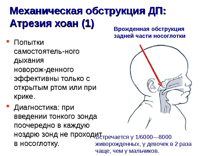 Атрезия хоан презентация