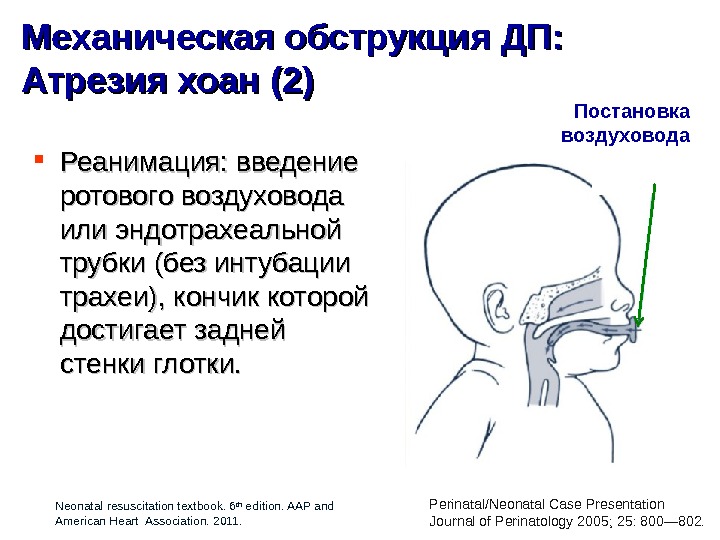 Атрезия хоан презентация