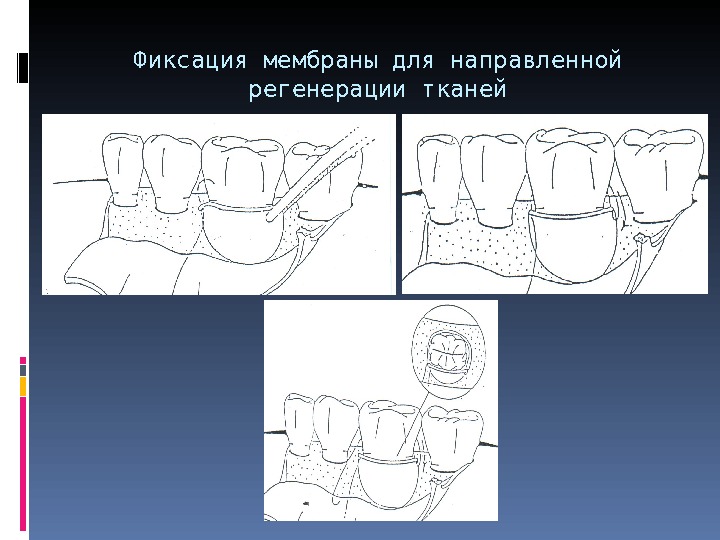 Техника направленная. Мембраны для направленной тканевой регенерации. Методика направленной регенерации тканей. Материалы для мембран.. Фиксация ткани.