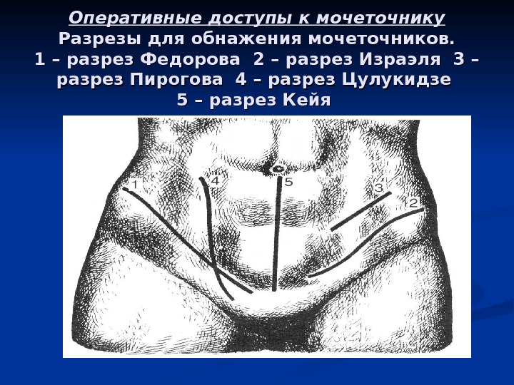 Нефроэктомия