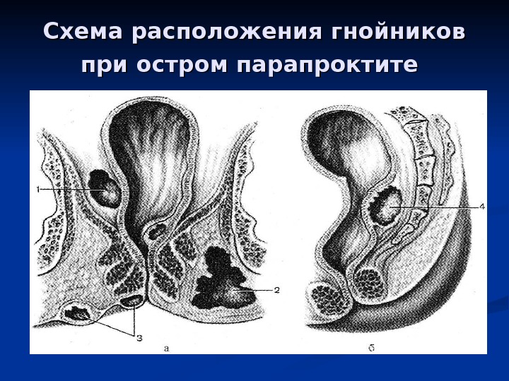 Парапроктит больница