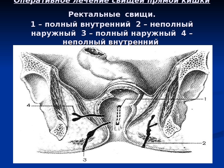 Внутренние операции. Парапроктит ректальный свищ,. Неполный параректальный свищ. Транссфинктерные свищи прямой кишки.