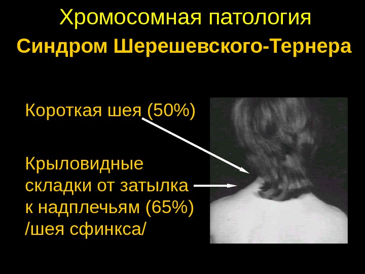 Синдром шерешевского тернера презентация неврология