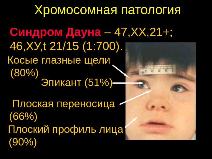 Хромосомная патология. Синдром Дауна патологии. Аномалии синдрома Дауна. Хромосомные аномалии синдромы.