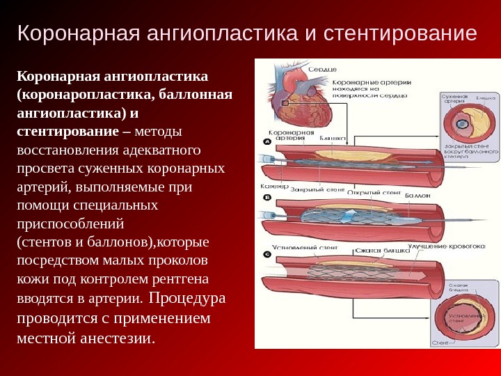 Какие лекарства после стентирования. Баллонная ангиопластика сосудов сердца. Баллонная дилатация венечных артерий. Баллонная ангиопластика и стентирование. Эндоваскулярная баллонная ангиопластика.