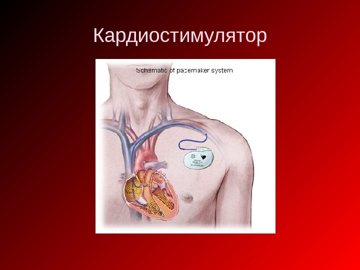 Установка кардиостимулятора