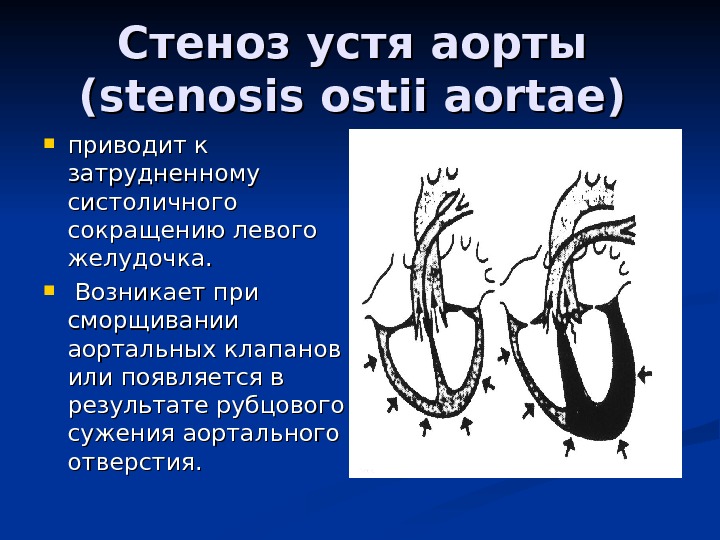 Аортальный стеноз презентация