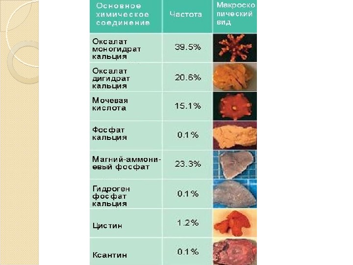 Мочекаменная болезнь при беременности презентация