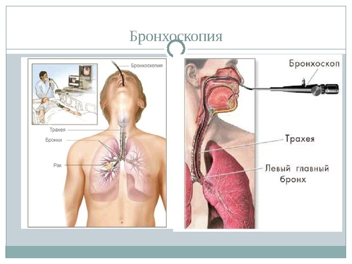 Ожог дыхательных путей. Бронхоскопия через нос. Бронхи и легкие бронхоскоп.