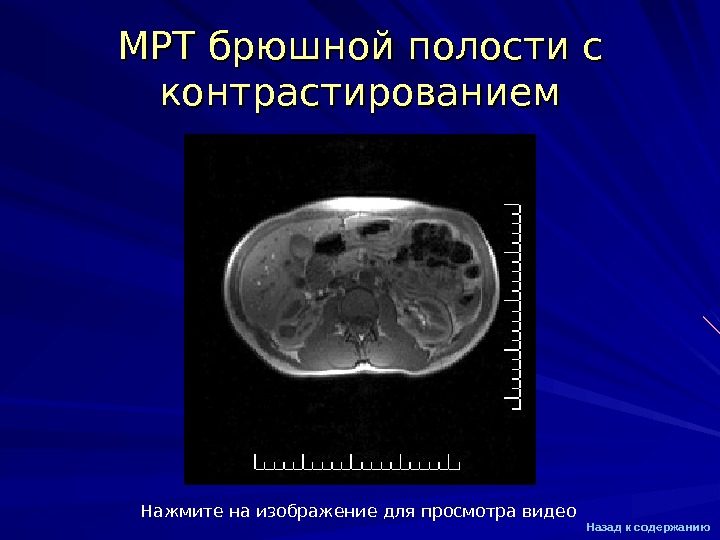 Подготовка к мрт брюшной полости. Мрт органов брюшной полости презентация. Диета перед мрт брюшной полости. Диета перед мрт брюшной полости с контрастированием. Питание перед мрт брюшной полости с контрастированием.