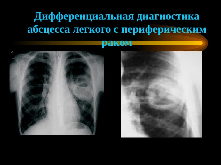 Нагноительные заболевания легких и плевры презентация