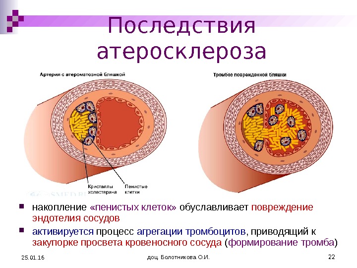 Схема развития атеросклероза