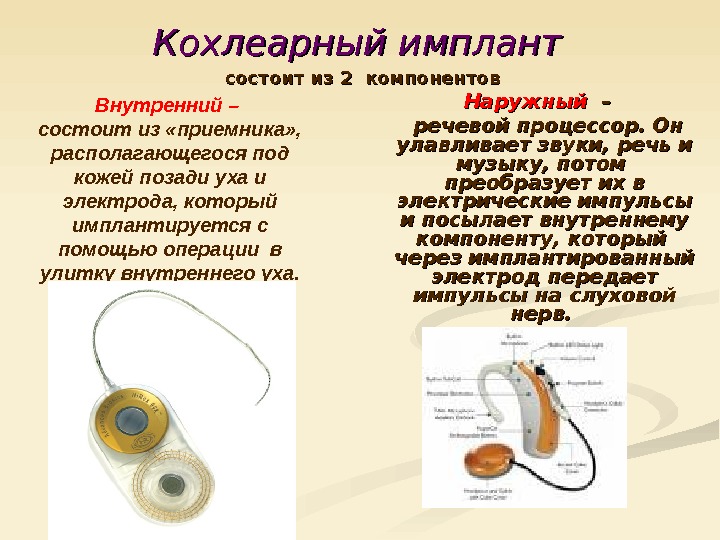 Устройство кохлеарного импланта. Кохлеарная имплантация речевой процессор. Процессор кохлеарного импланта. Кохлеарный имплантат схема. Кохлеарный имплант устройство.