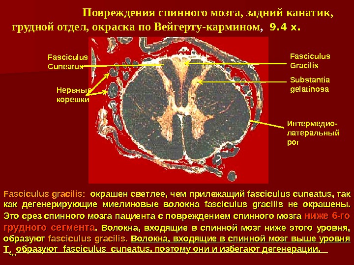 Канатики спинного мозга. Спинной мозг гистология задние канатики. Повреждение спинного мозга. Повреждение заднего канатика спинного мозга. Спинной мозг окраска по Вейгерту.