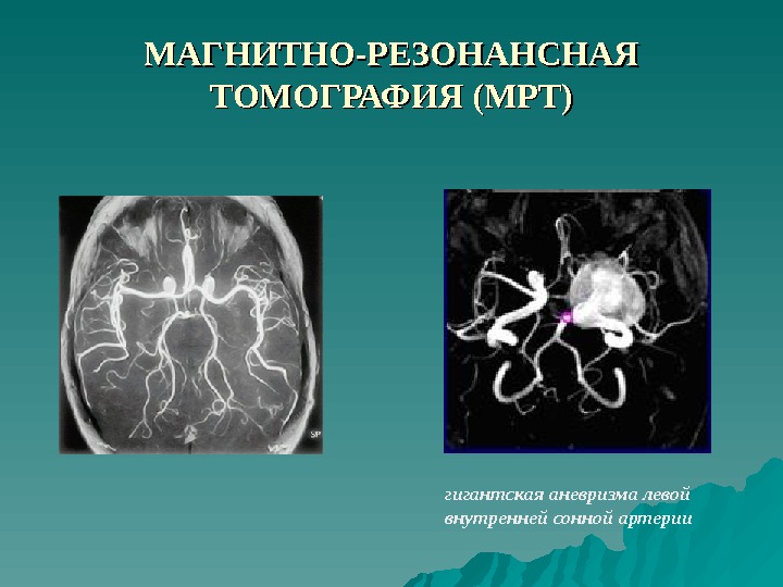 Мешотчатые аневризмы вса. Аневризма внутренней сонной артерии кт. Кт ангиография аневризма. Аневризма ВСА головного мозга. Аневризма супраклиноидного отдела ВСА.