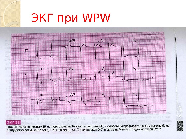 Wpw на экг фото