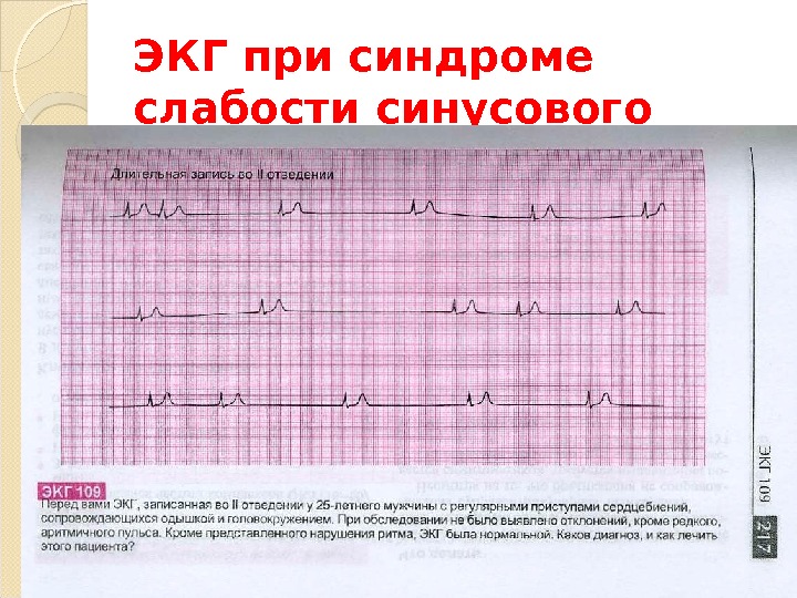 Синдром слабости синусового узла карта вызова смп