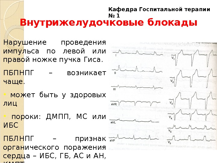 Нарушение проводимости на экг. Блокада межжелудочковой перегородки на ЭКГ. Блокада внутрижелудочкового проведения ЭКГ. Внутрижелудочковая блокада. Блокада левой ножки пучка Гиса.. Внутрижелудочковые блокады на ЭКГ.