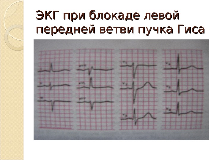 Блокада передней левой ножки гиса