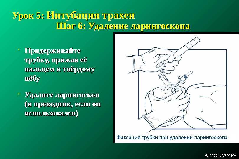 Интубация трахеи. Ларингоскоп для интубации трахеи. Проводник при интубации трахеи. Интубация трахеи через Ларингоскоп. Протокол интубации трахеи в реанимации.