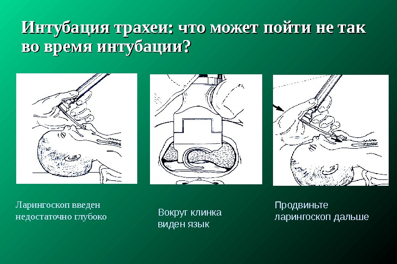 Интубация трахеи картинки