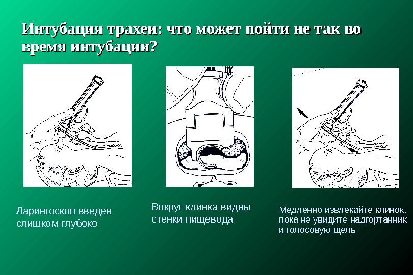 Интубация трахеи презентация