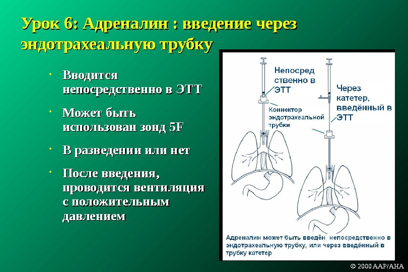 Адреналин новорожденным