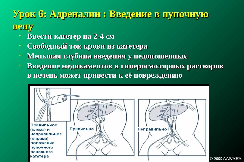 Адреналин новорожденным