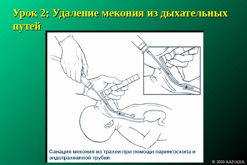 Санация это в медицине. Санация дыхательных путей. Санация дыхательных путей с помощью. Аспирация содержимого дыхательных путей. Проведение санации дыхательных путей у детей.